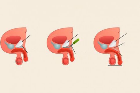 pred a po operácii na zväčšenie penisu